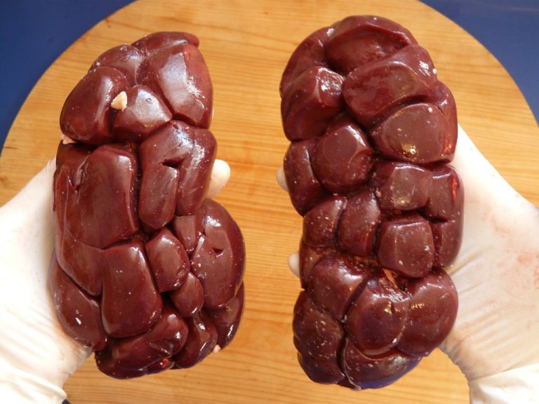 Kidneys - Is Keto Bad for Your Kidneys?